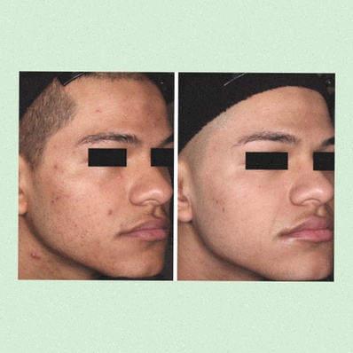 tazarotene crema